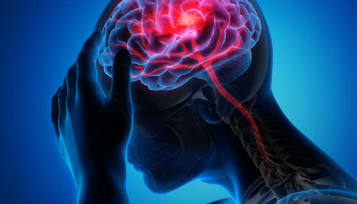Selain Lumpuh, Ternyata Tanda Ini Juga Bisa Indikasi Gejala Stroke