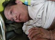 Alami Gatal dan Kulit Melepuh, Rustam Butuh Uluran Tangan Dermawan