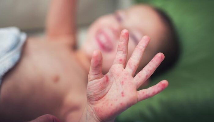 Kasus Campak dan Cacar Air Meningkat di Pariaman